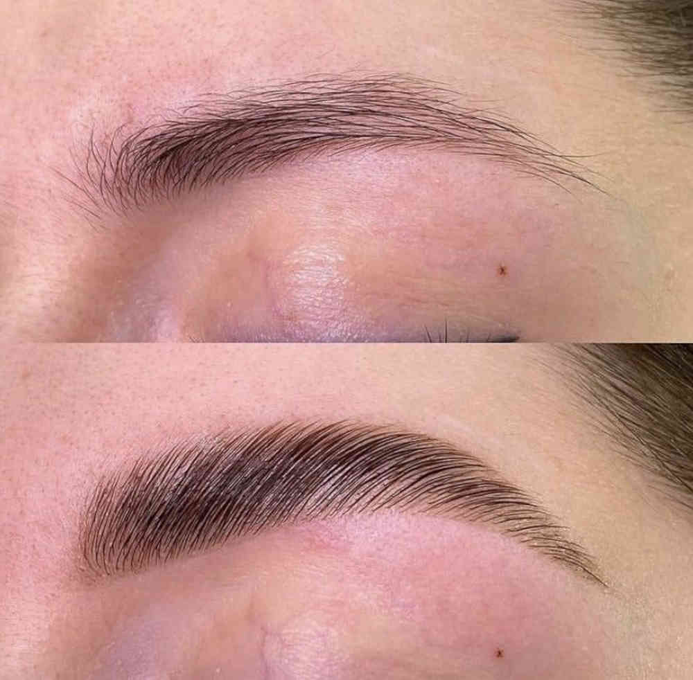 Browlift