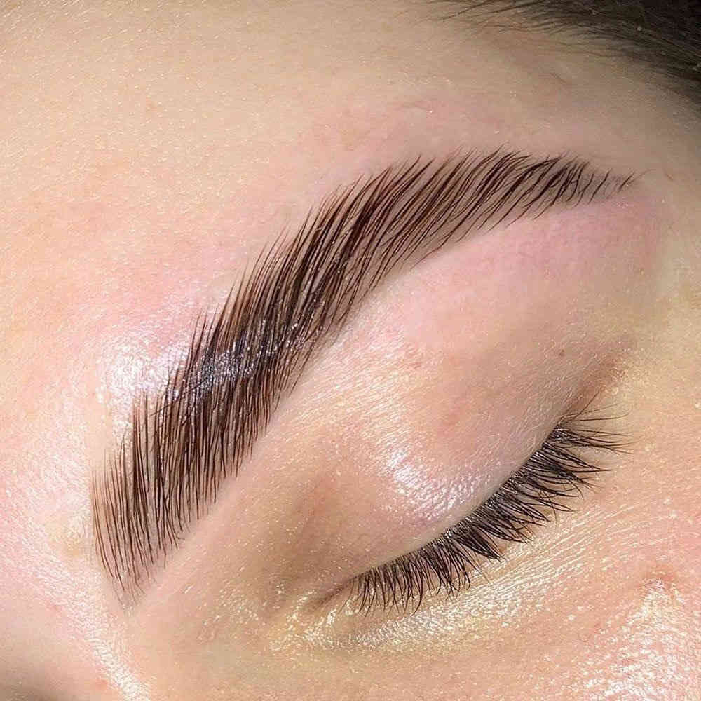 Browlift